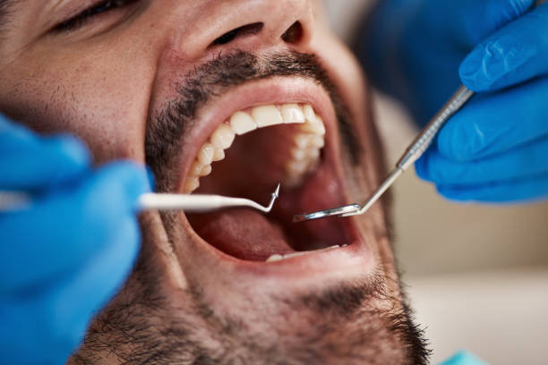 Best Emergency Tooth Extraction in Crown Pot, IN